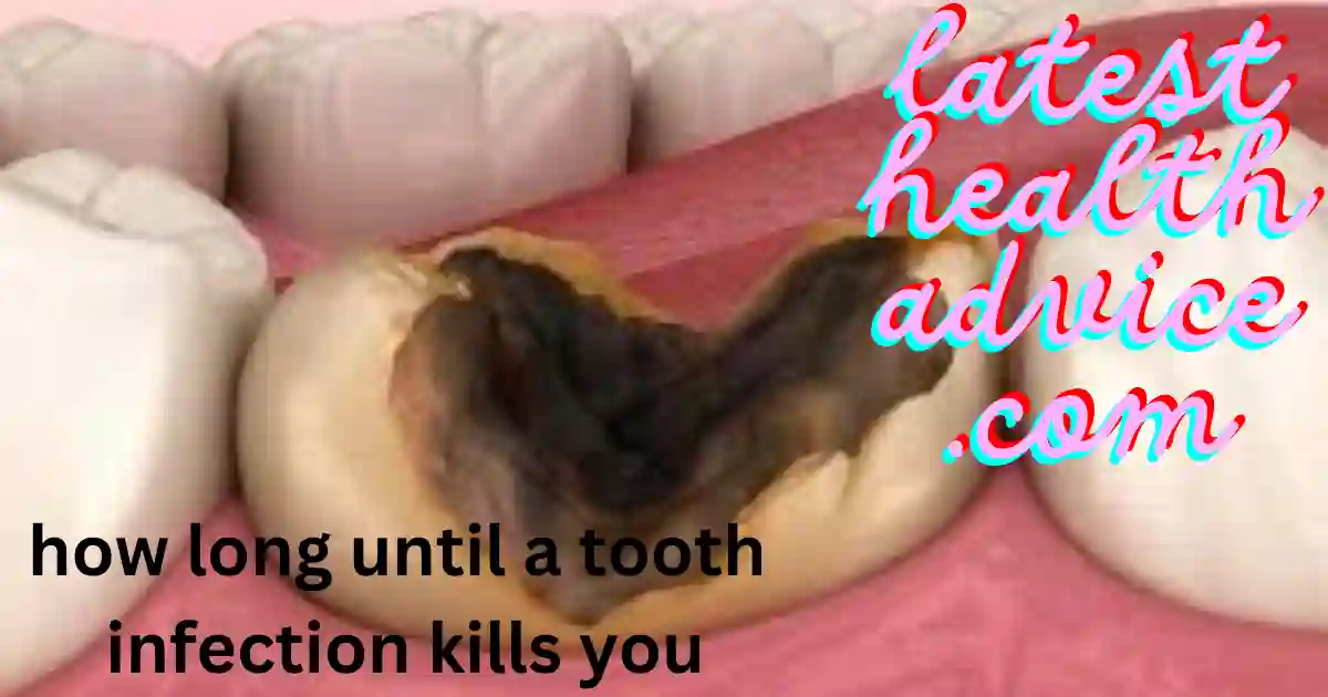 How Long Until A Tooth Infection kills you