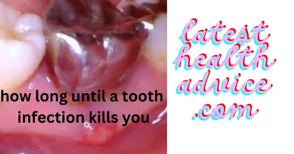 How Long Until A Tooth Infection kills you