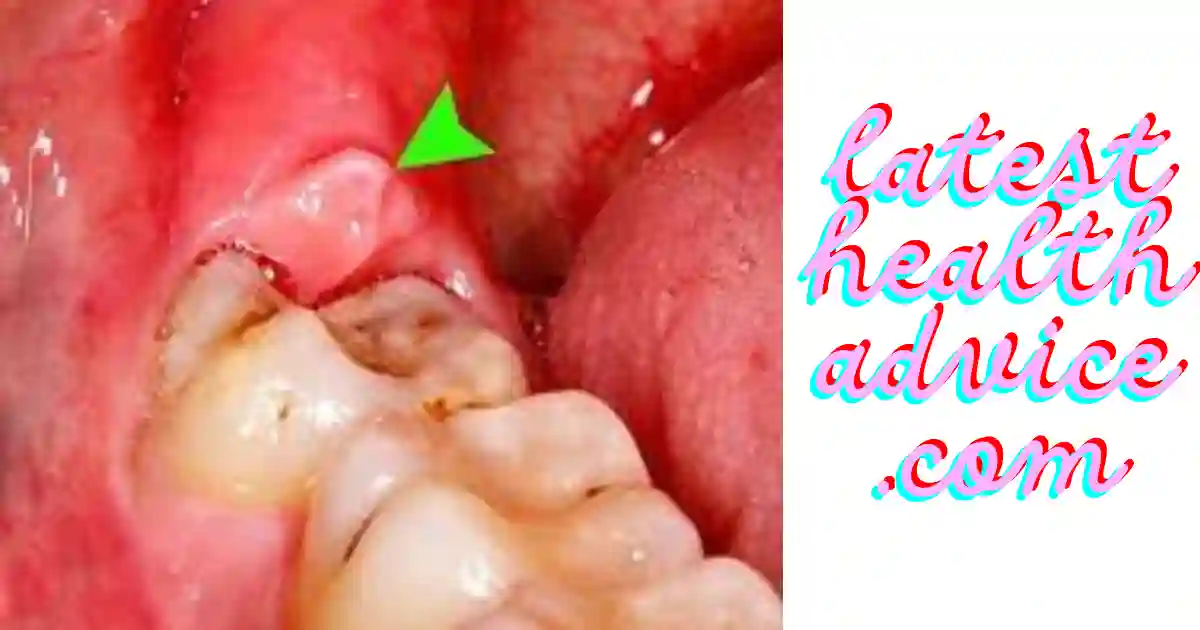 Signs of Wisdom Teeth Infection