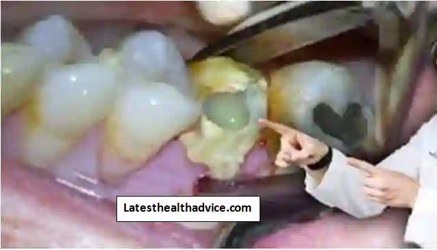 Extract A Tooth That Is Infected