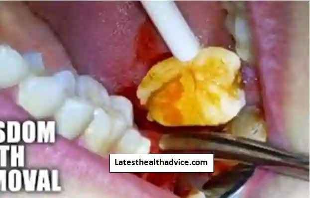 Extract A Tooth That Is Infected